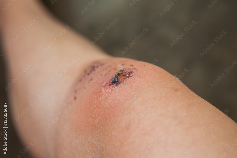 Scratch on the knee caused by a fall. Scratch on the knee caused by a fall.