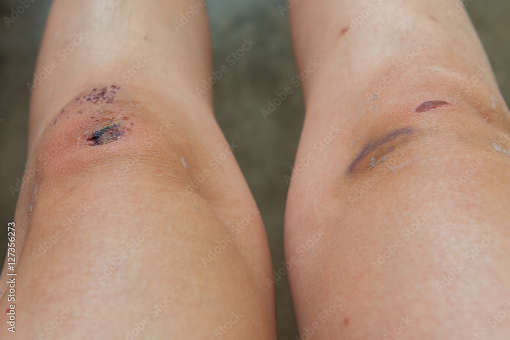 Fototapeta premium Scratch on the knee caused by a fall.