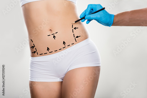 Surgeon Drawing Correction Lines On Woman's Stomach photo