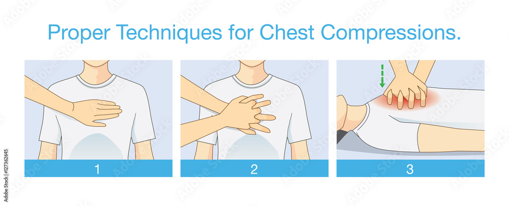 Proper techniques for chest compression. Illustration about emergency help  and perform CPR. First aid for person has stopped breathing. Stock Vector