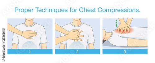 Proper techniques for chest compression. Illustration about emergency help and perform CPR. First aid for person has stopped breathing. 
