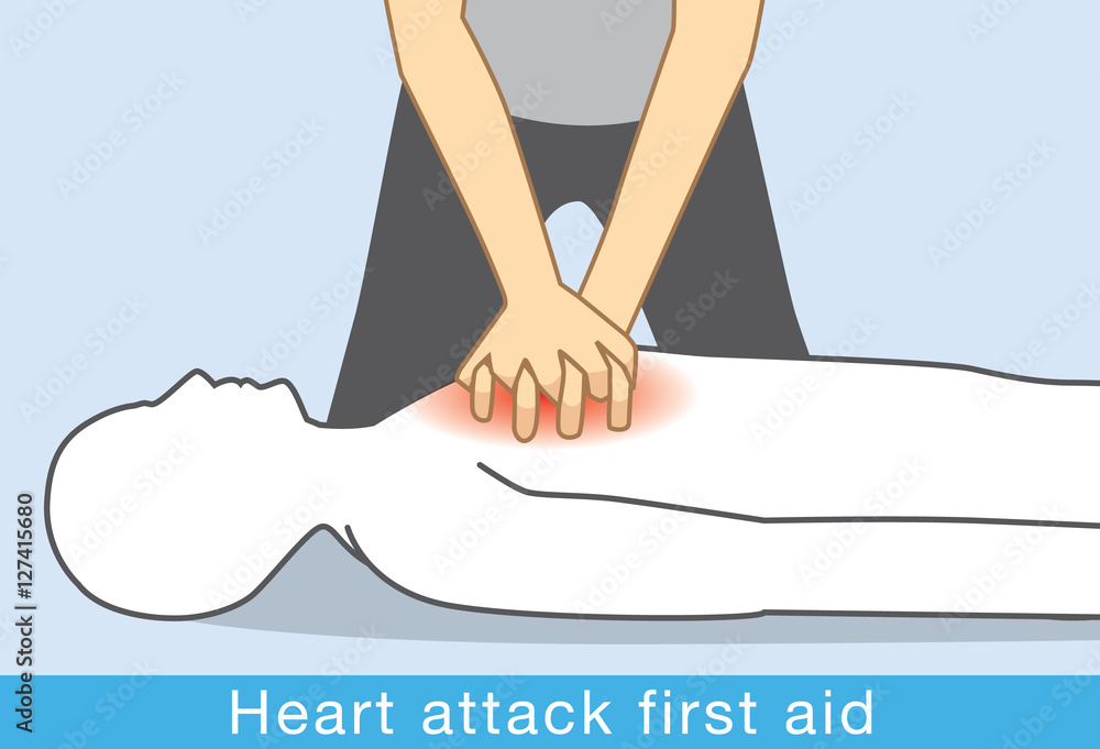 Hand push hard and fast in the center of chest of Heart attack people. First aid for Heart