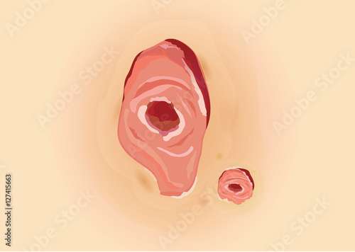 Skin ulcers of Diabetic patients. Infected wounds. Illustration about health care and medical.