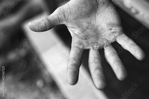 Palm with Calluses. Hard Work Concept. Blisters on the Injured Hand From Manual Work.