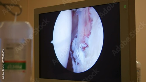 View of arthroscopic shoulder surgery on the display photo