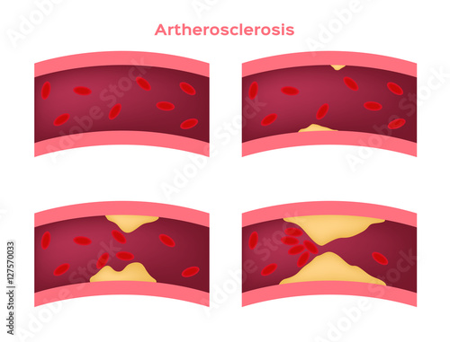 step of Atherosclerosis icon and vector . fat stuck in the blood artery