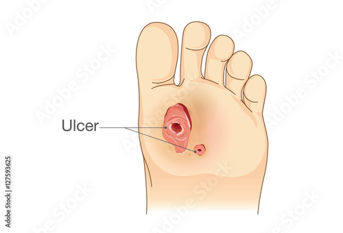 Diabetic Foot Pain and Ulcers. Skin Sores on Foot. Illustration about Diabetes Symptoms.