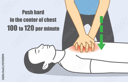 Hand push hard and fast in the center of chest 100 to 120 per minute. Illustration about perform CPR for person has stopped breathing. 