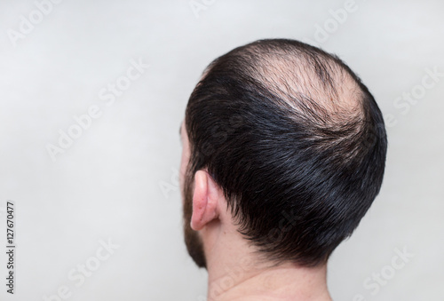 male head with thinning hair or alopecia
