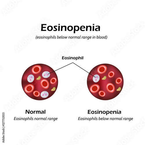 Eosinophils below normal range in blood. Eosinopenia. Infographics. Vector illustration