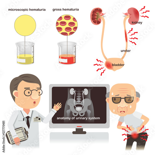 Hematuria Blood in Urine Signs Causes and Treatment. Vector illustrations
