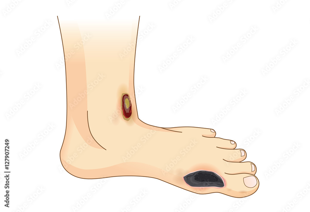 Diabetic Foot Pain and Ulcers. Skin Sores on Foot side view
