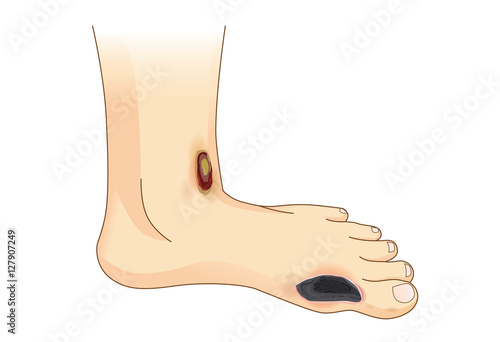 Diabetic Foot Pain and Ulcers. Skin Sores on Foot side view. Illustration about Diabetes Symptoms.