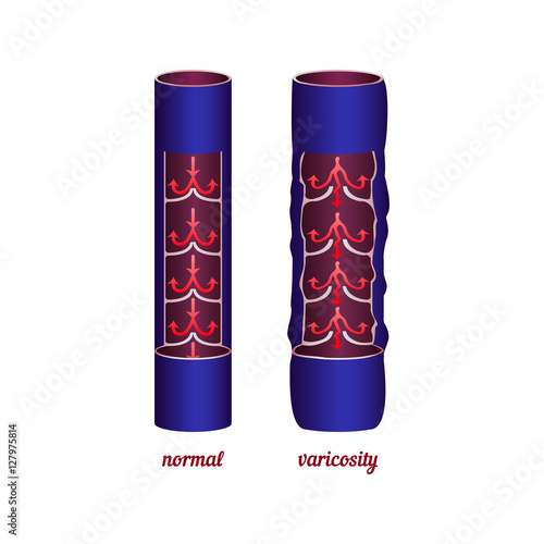 Comparing normal veins and varicose.