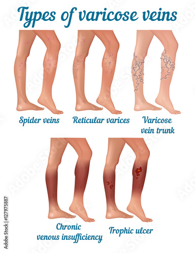 Types of varicose veins.
