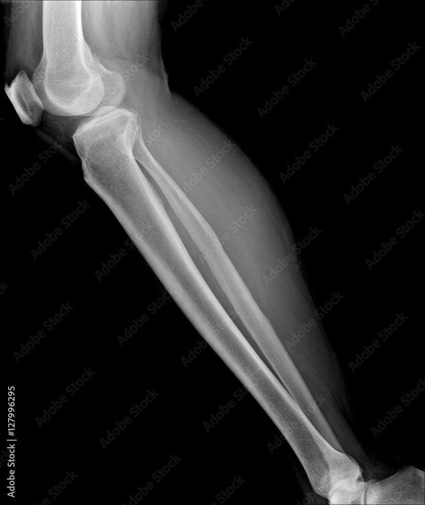X-ray image of shin , side view