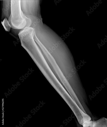 X-ray image of shin , side view photo