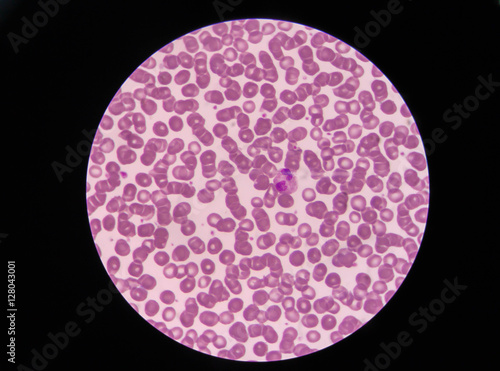Blood smear shows rouleaux formation and neotrophil