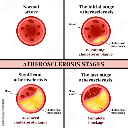 Atherosclerosis stages. Cholesterol plaques.
Disturbance of lipid and protein metabolism, adjournment the cholesterol plaques in arteries. photo