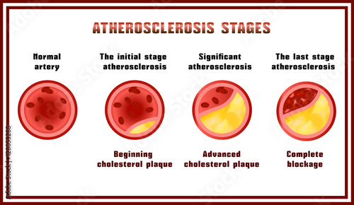 Atherosclerosis stages. Cholesterol plaques.
Disturbance of lipid and protein metabolism, adjournment the cholesterol plaques in arteries.