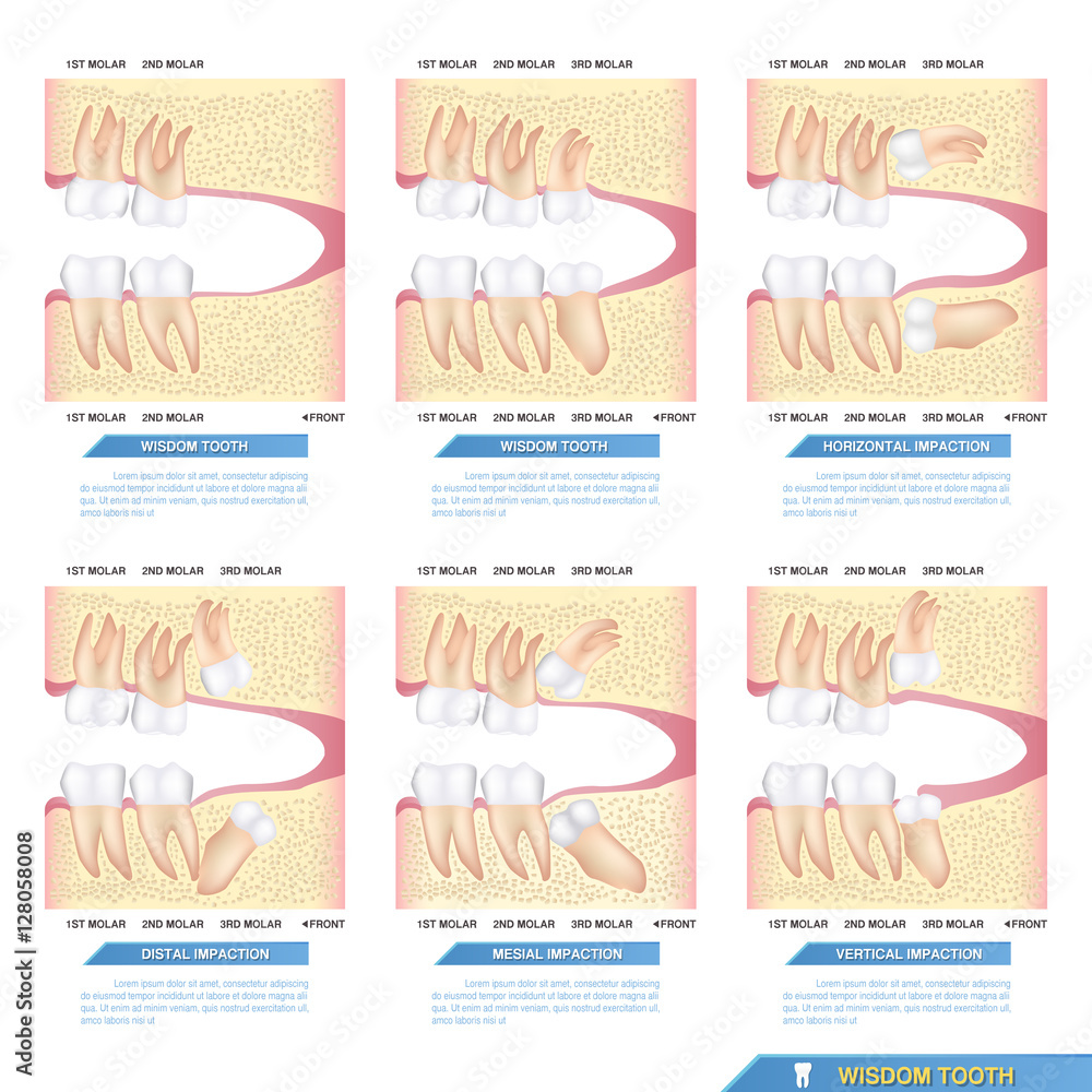 set-of-impacted-wisdom-tooth-dental-problems-horizontal-mesial