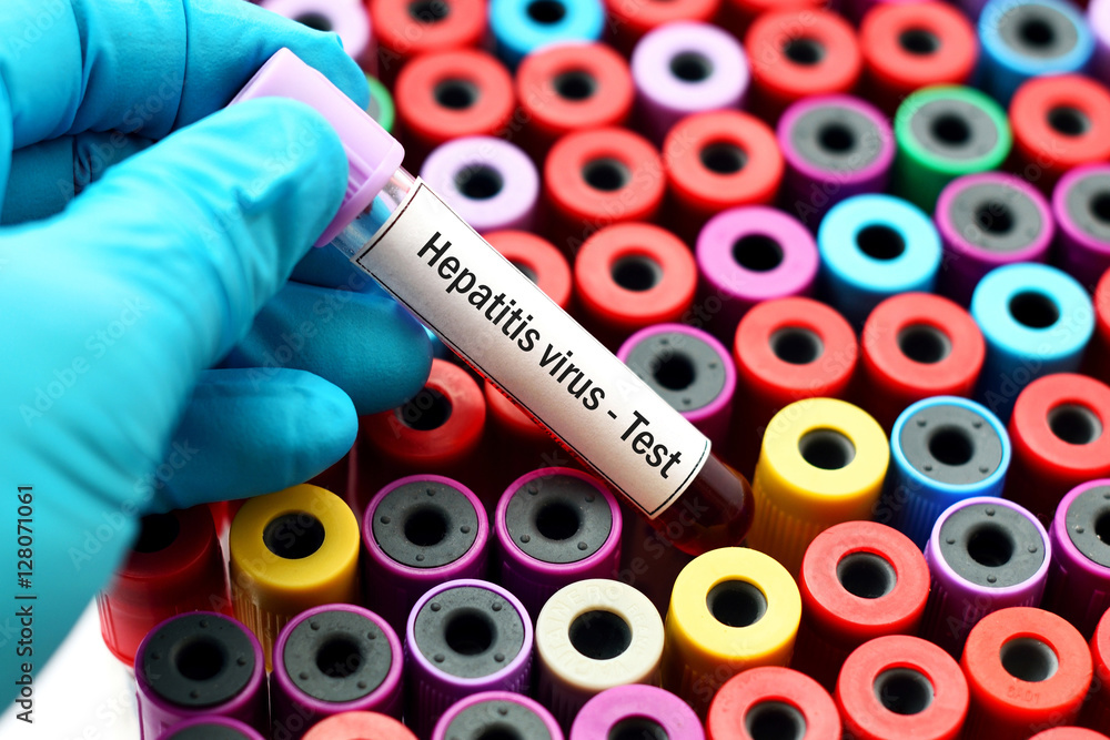 Fototapeta premium Hepatitis virus test