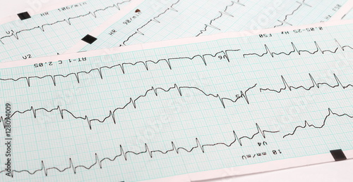 EKG arrhythmia absoluta, printout background