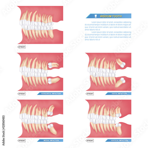 set of impacted wisdom tooth, dental problems, horizontal, mesial, vertical, distal impaction..