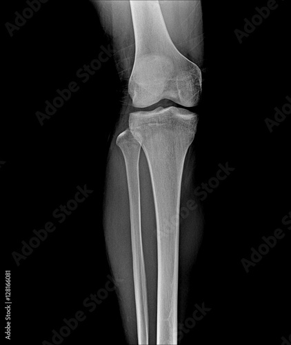 Film x-ray knee AP/lateral : Osteoarthritis knee (Inflammation at knee) , front view