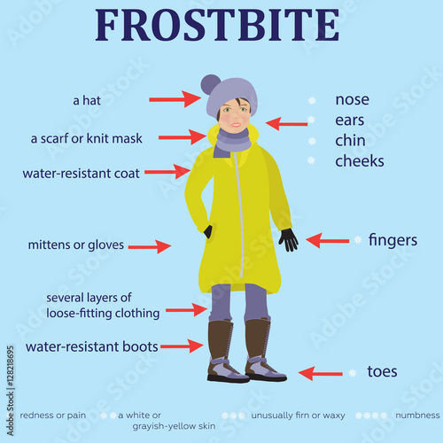 Frostbite. How to prevent. Often zone lesions and symptoms.