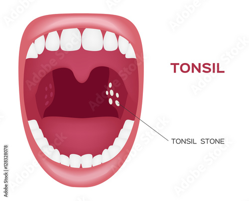 normal tonsil , tonsil stone in the mouth vector