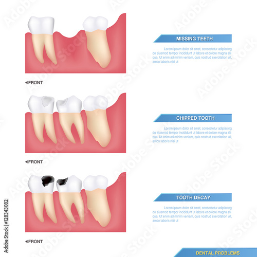 set of dental problems, missing teeth, chipped tooth and tooth decay..