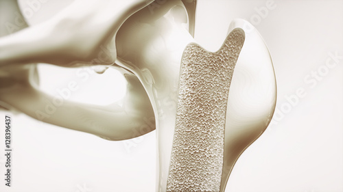 Osteoporosis stage 1 of 4 - upper limb bones - 3d rendering