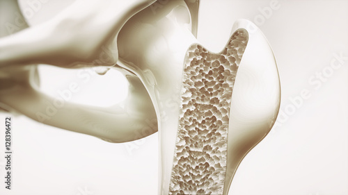 Osteoporosis stage 4 of 4 - upper limb bone - 3d rendering