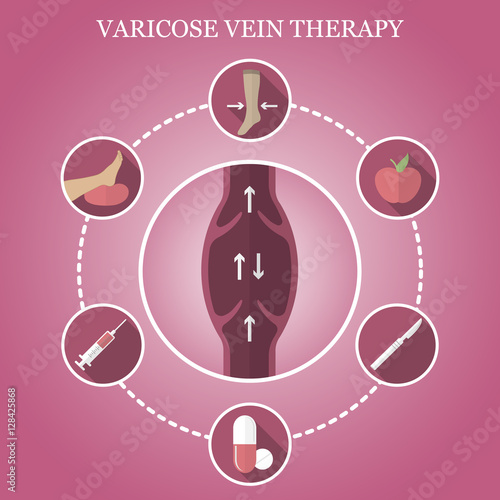 Infographics phlebology, treating varicose veins on women's legs. Varicose vein icons.