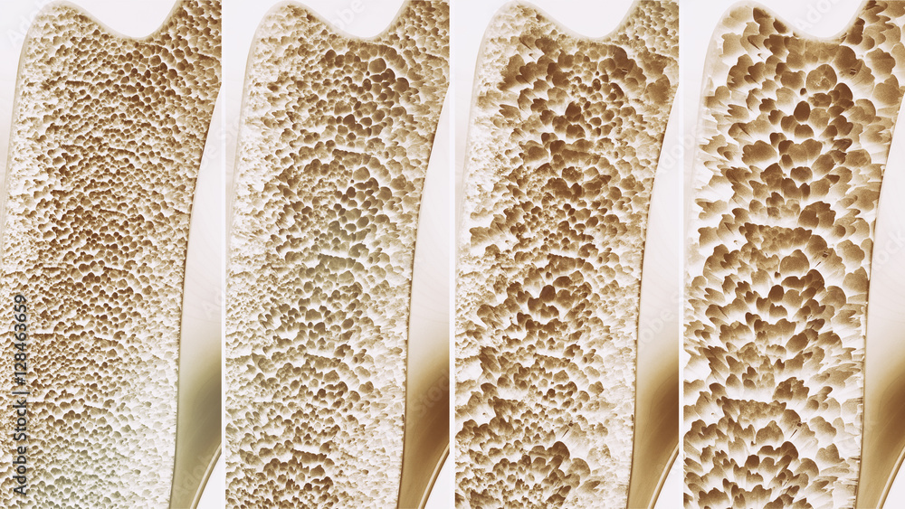 Osteoporosis 4 stages - 3d rendering - obrazy, fototapety, plakaty 