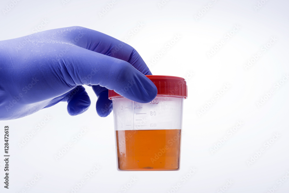 Medical Urine Specimen Jar Medical Urine Specimen Jar