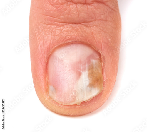 one finger of the hand with a fungus on the nails isolated white background