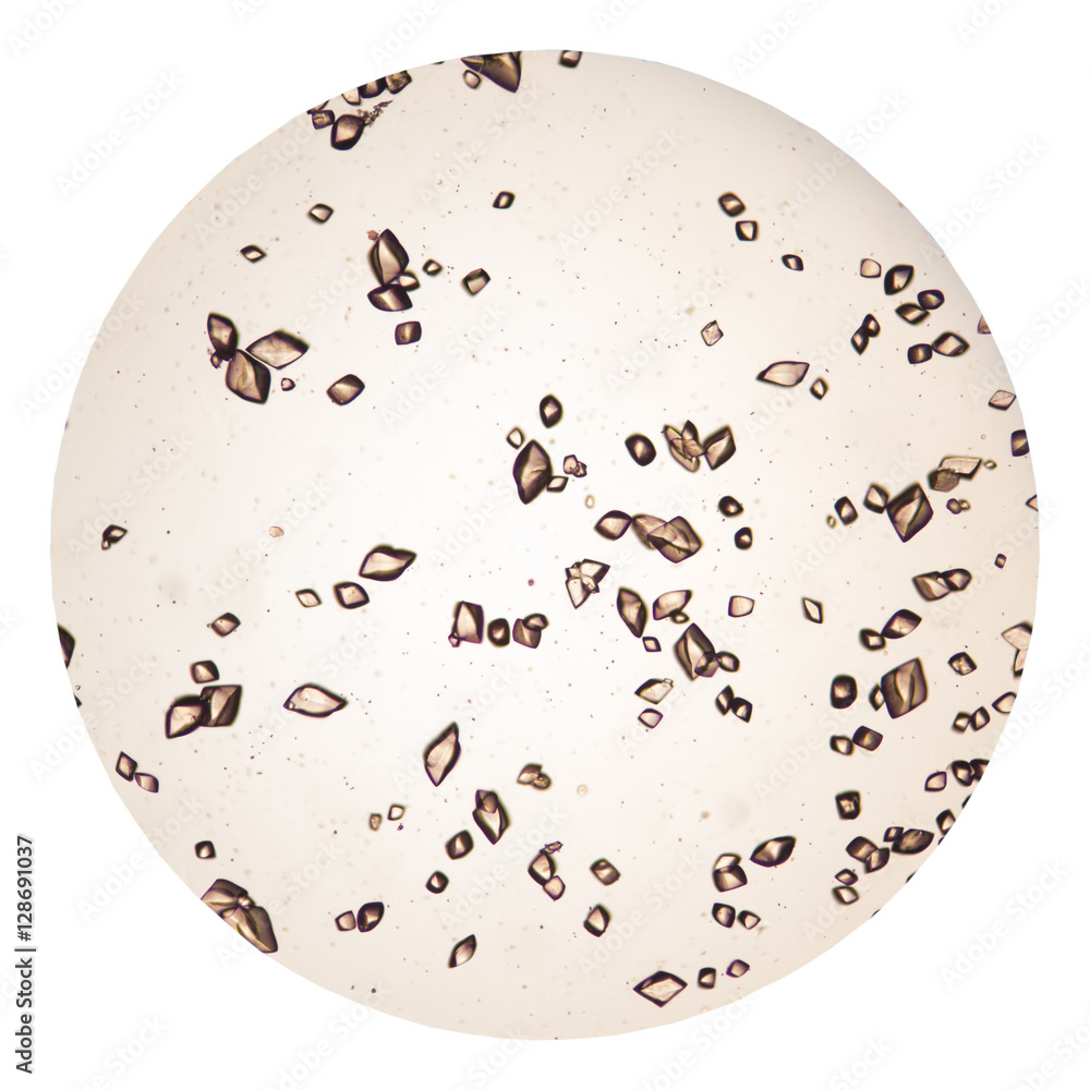 Uric Acid Crystal In Urine Sediment Foto De Stock Adobe Stock