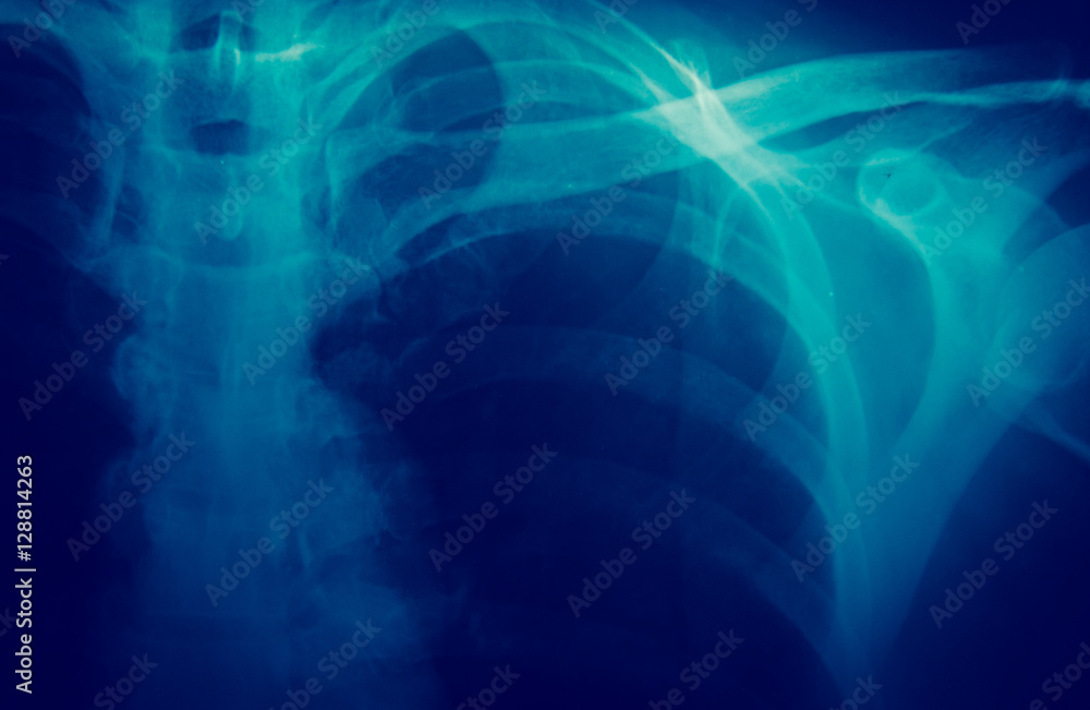 X-ray X-ray