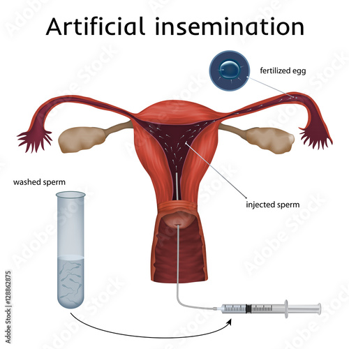 Artificial insemination. The fertilized egg, washed, injected sperm, uterus, womb, syringe. Anatomy illustration. White background.