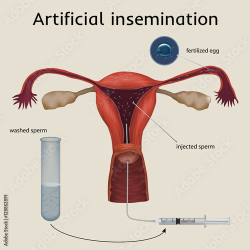 Artificial insemination. The fertilized egg, washed, injected sperm, uterus, womb, syringe. Anatomy illustration. Beige background.