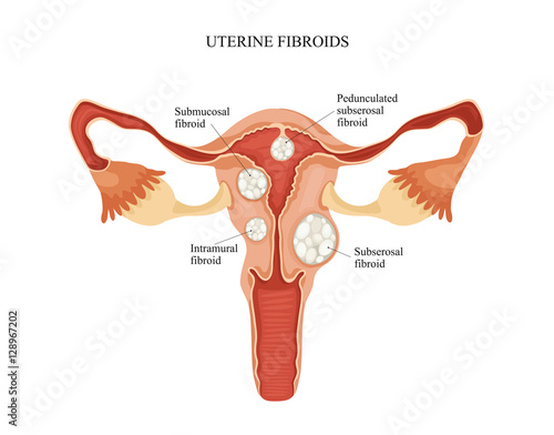 Uterine fibroid photo