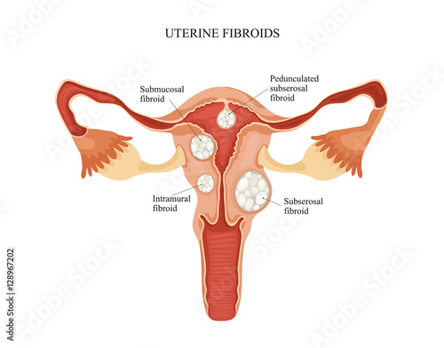 Uterine fibroid