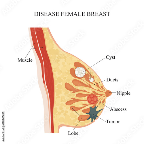 Disease female breast