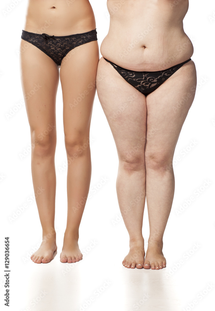 a woman's legs, comparing fat vs. skinny Photos | Adobe Stock