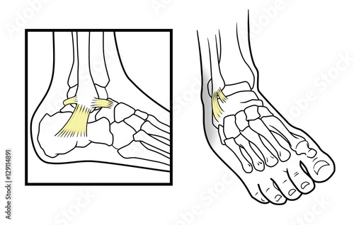 Dislocation of ankle, Dislocated ankle diagram on a white background photo