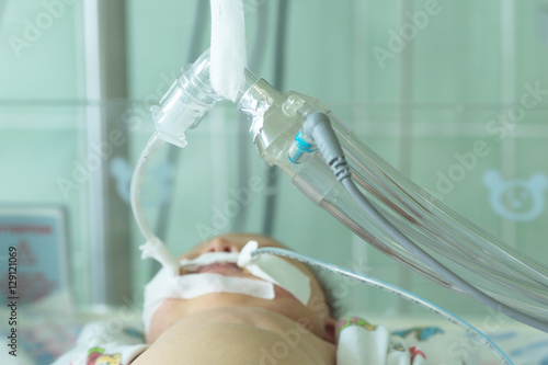 Newborn baby on breathing machine or ventilator with orogastric tube