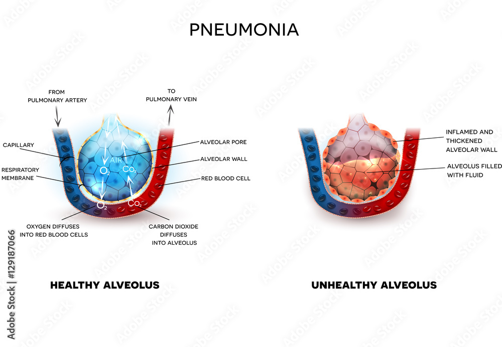 Fotografía Pneumonia illustration, alveoli with fluid and healthy ...