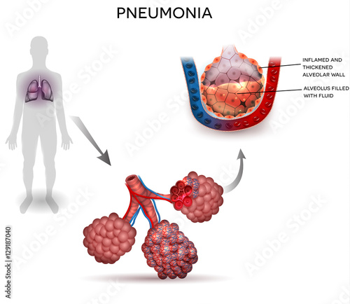 Pneumonia illustration, human silhouette with lungs, close up of alveoli and inflamed alveoli with fluid inside.